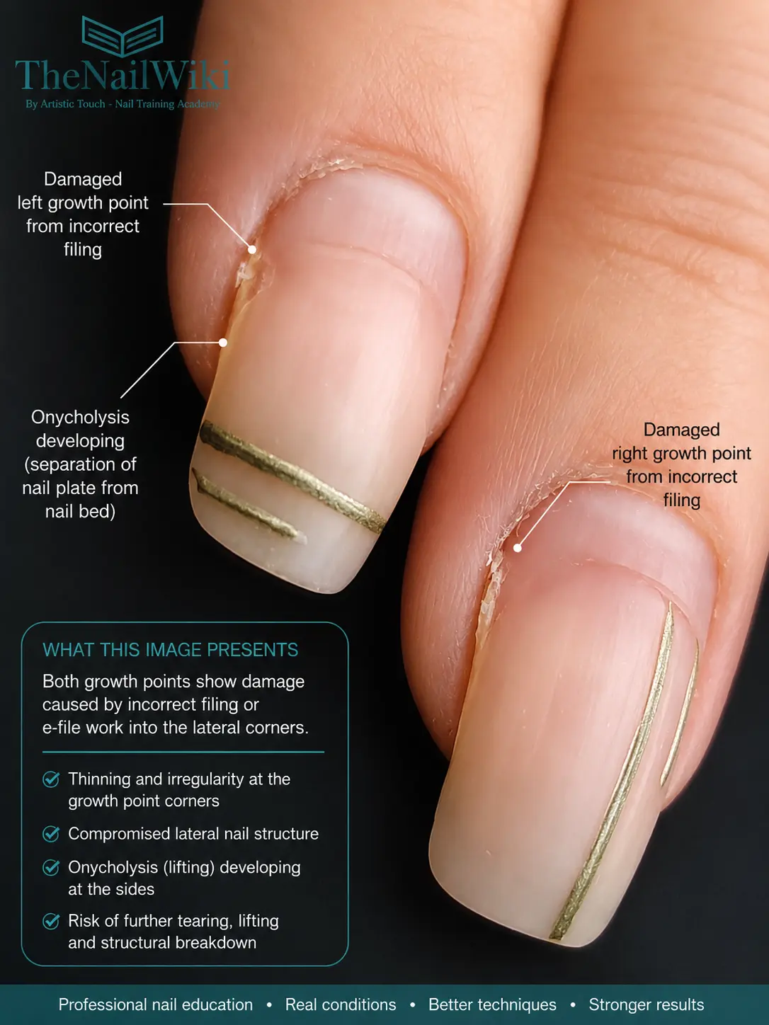 Real client nail showing damaged growth points on both sides from incorrect filing — thinning and irregularity at the lateral corners with onycholysis developing at the sides