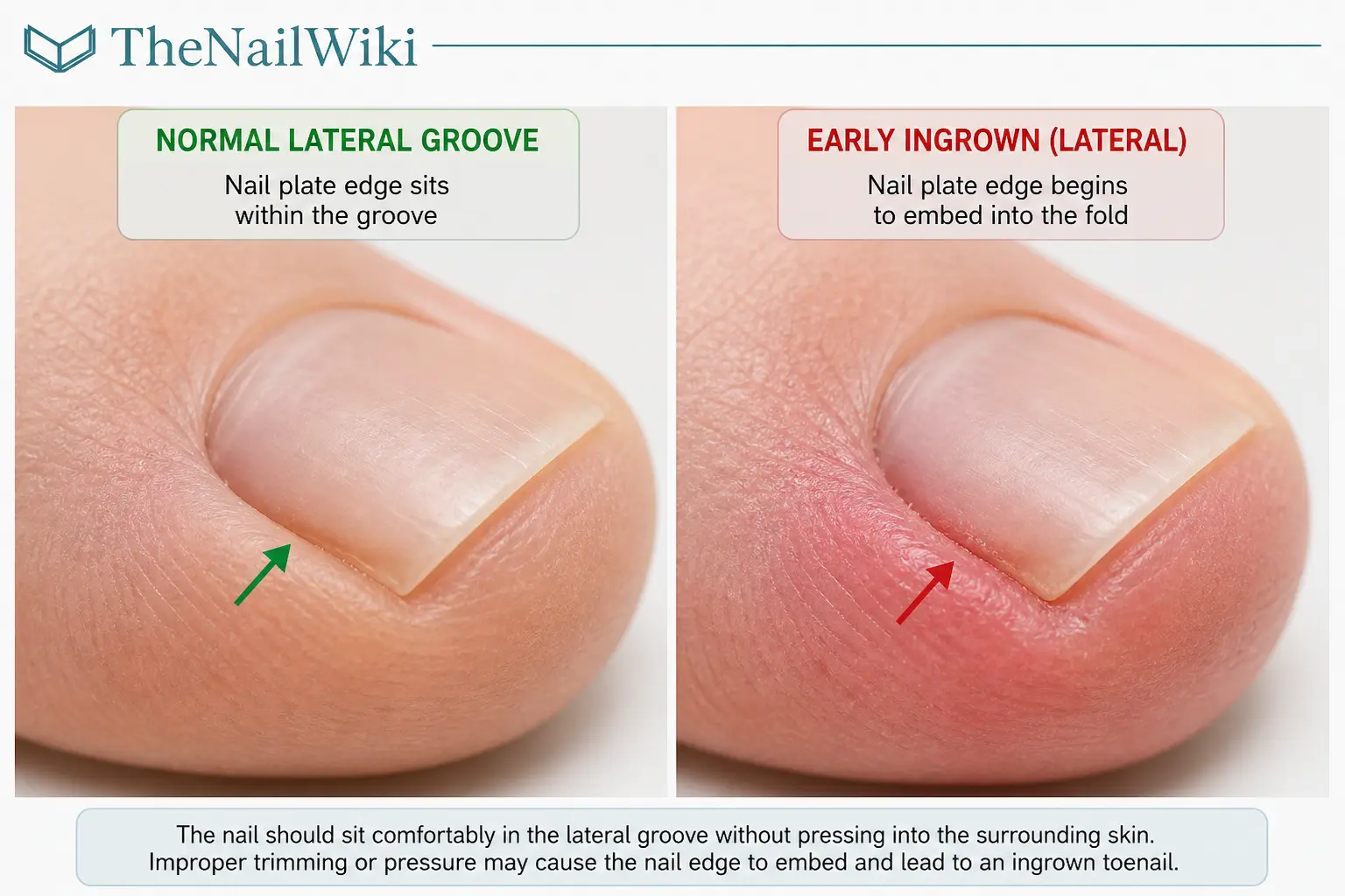 Close-up of the lateral nail groove area showing the nail plate edge correctly guided within the groove versus beginning to embed into the lateral fold