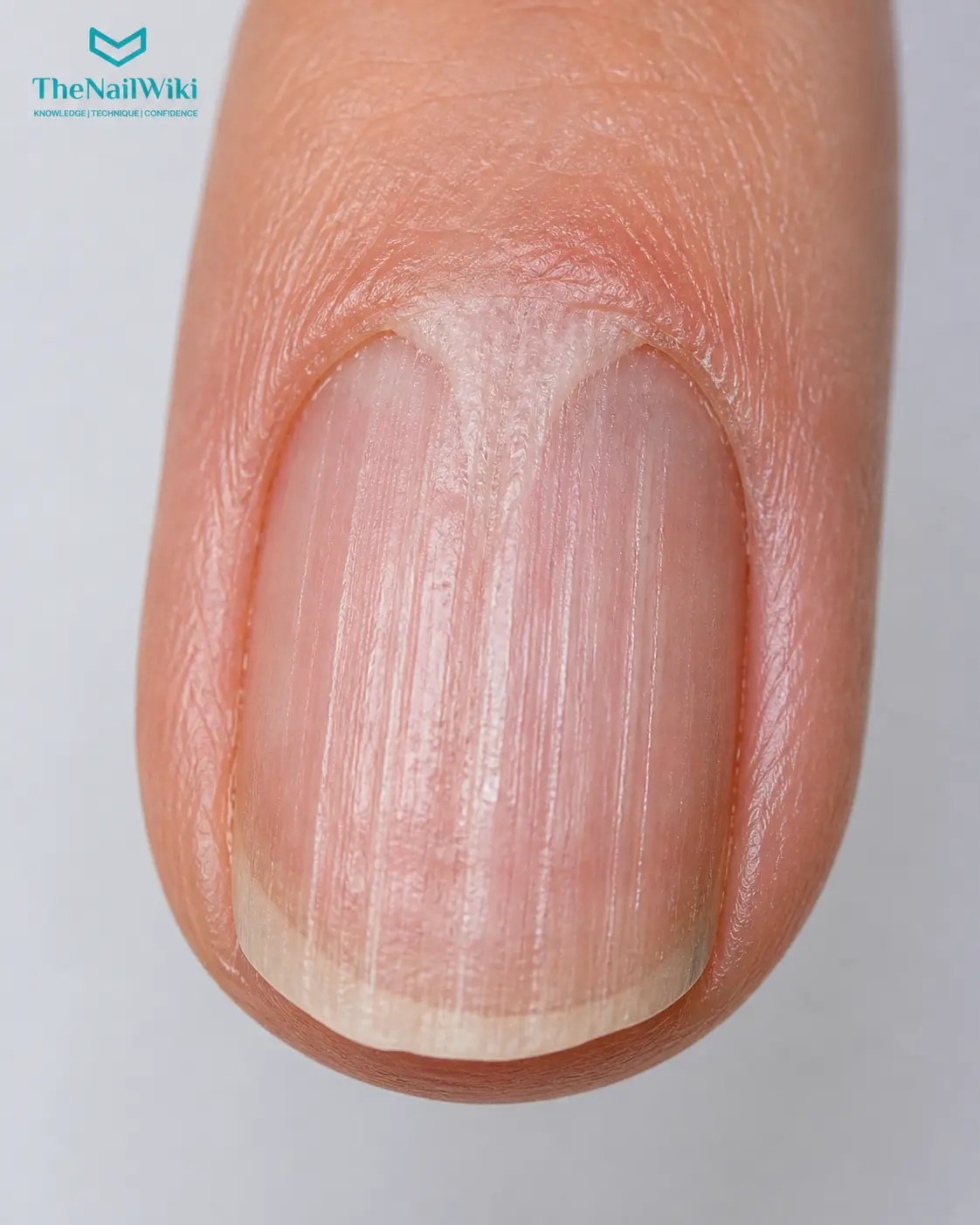 Nail lichen planus showing longitudinal ridging, nail plate thinning, and pterygium unguis — proximal nail fold skin migrating forward over the nail plate