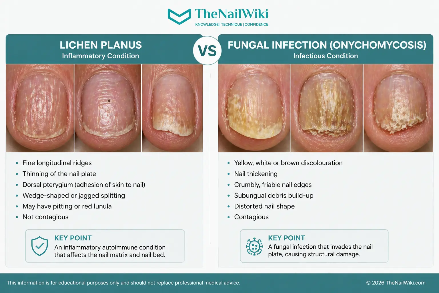 Side-by-side comparison of subungual hyperkeratosis and fungal nail infection showing the difference in texture, colour, and debris type
