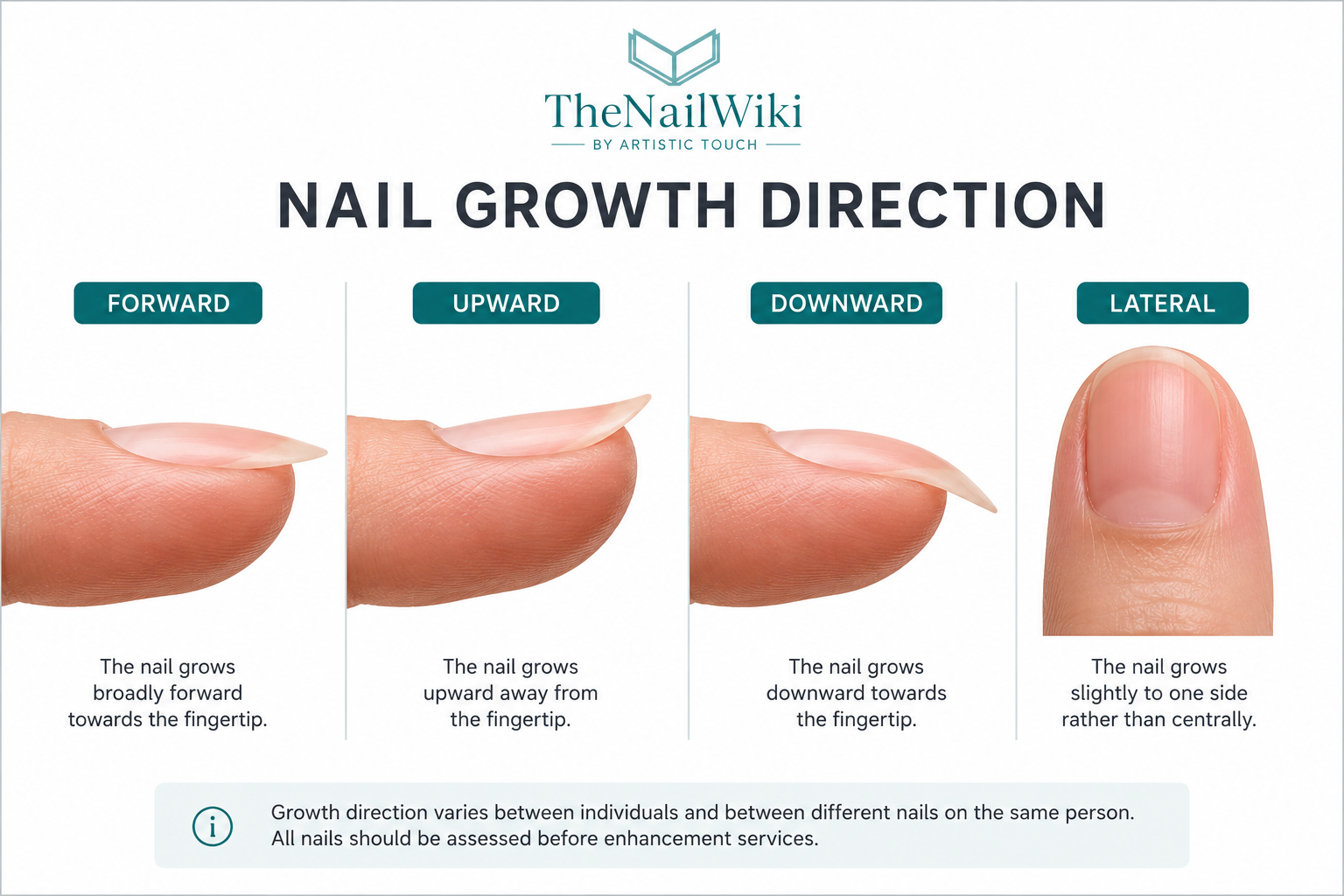 Comparison diagram of forward, upward, downward and lateral nail growth directions