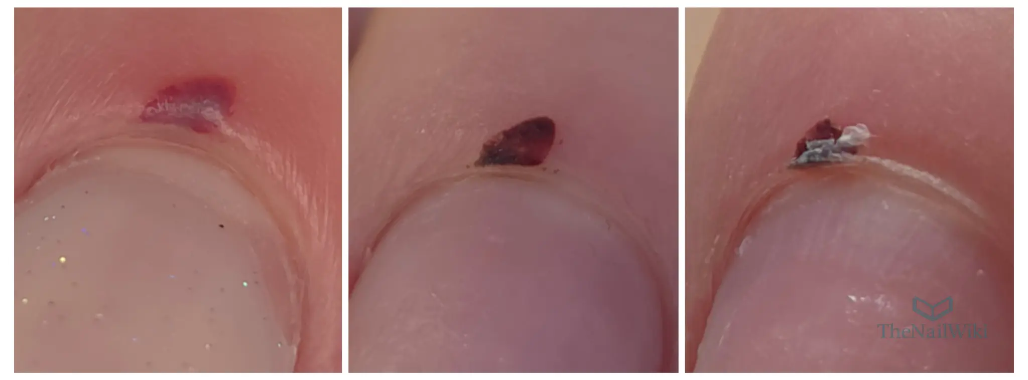 Cuticle haematoma healing progression showing fresh bruising, mid-stage healing after two weeks, and late-stage flaking during final healing phase over four to five weeks
