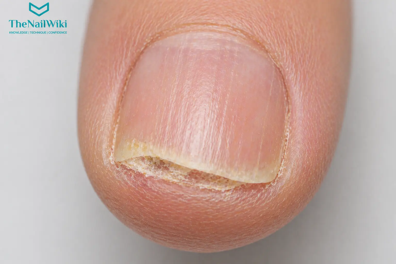 Subungual hyperkeratosis in nail psoriasis — keratinous scale build-up beneath the nail plate causing lifting and separation from the nail bed