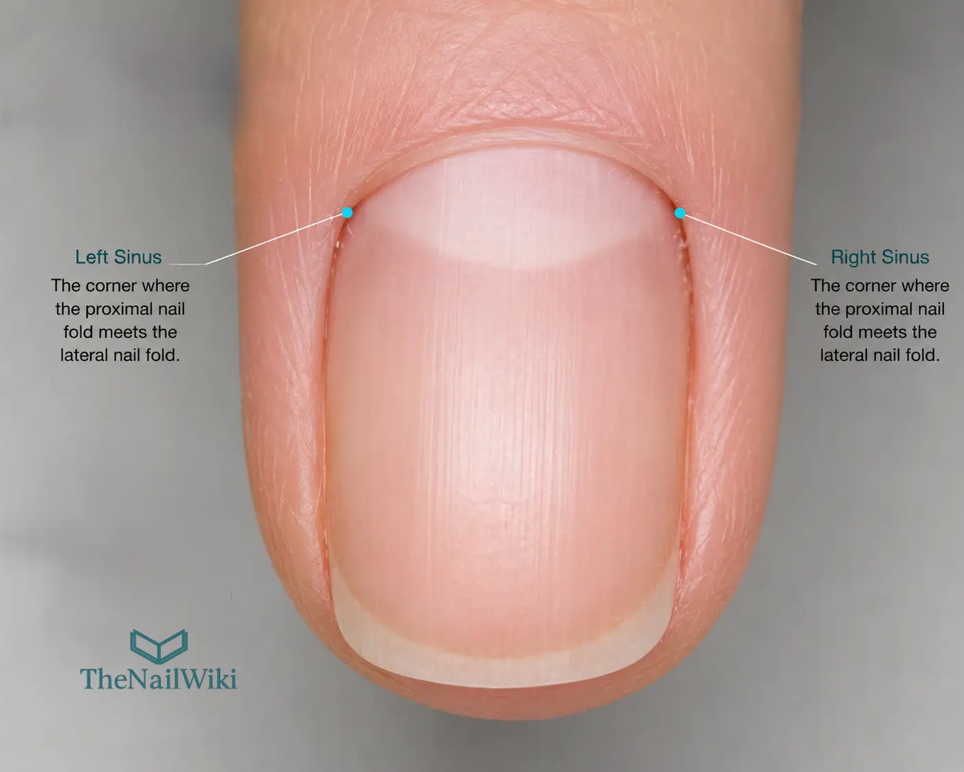 Close-up of a nail showing the two nail sinuses labelled — the tight corner recesses on each side where the proximal nail fold meets the lateral sidewall