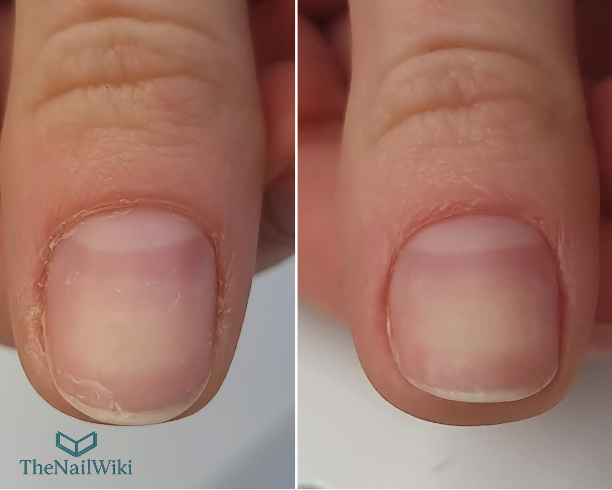 Before and after close-up of the proximal nail fold zone — left showing cuticle build-up on the nail plate, right showing clean defined cuticle line after professional Russian manicure preparation
