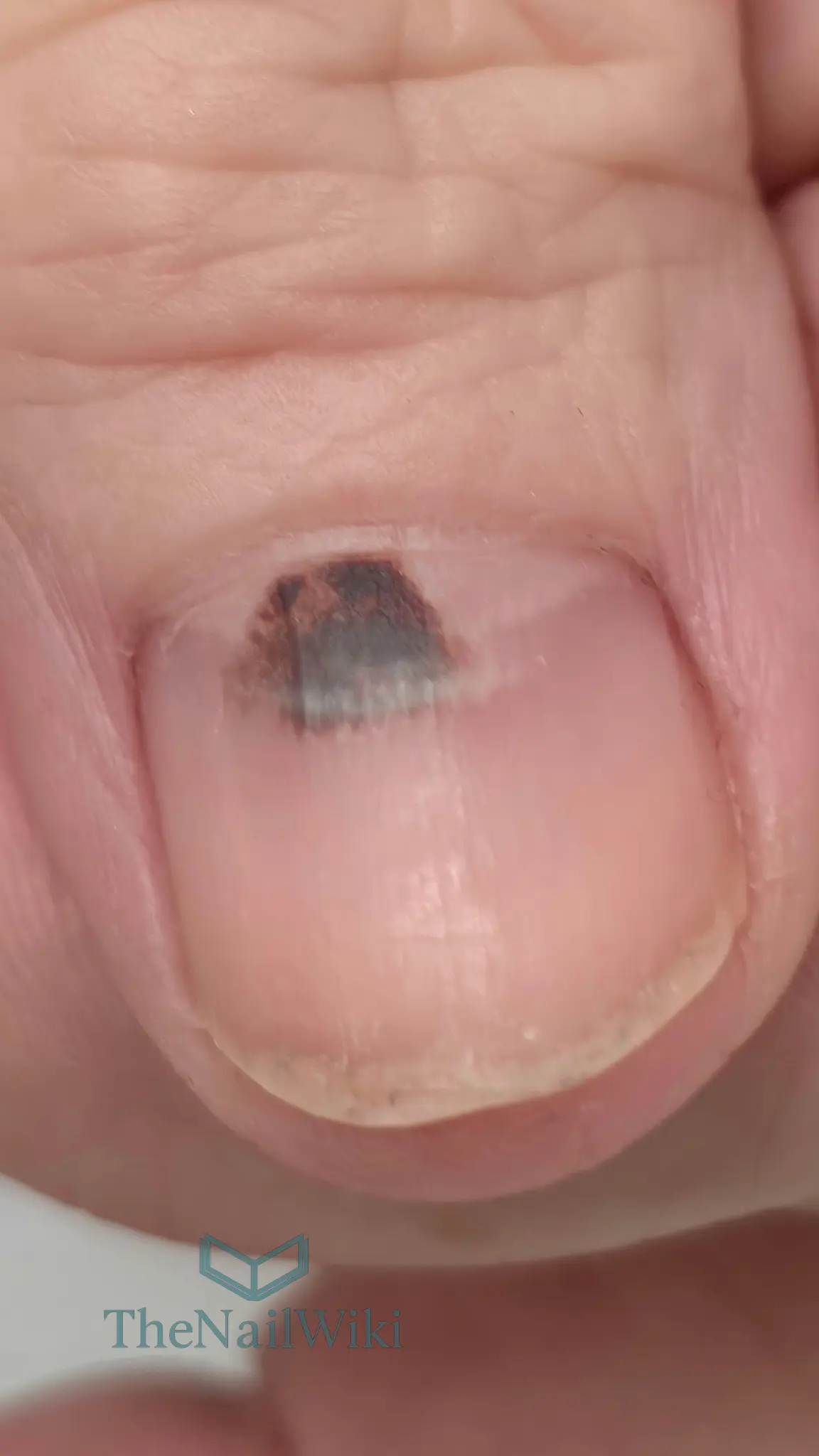 Subungual haematoma showing dark purple-brown blood pooled beneath the nail plate in the nail bed following trauma to the distal portion of the nail