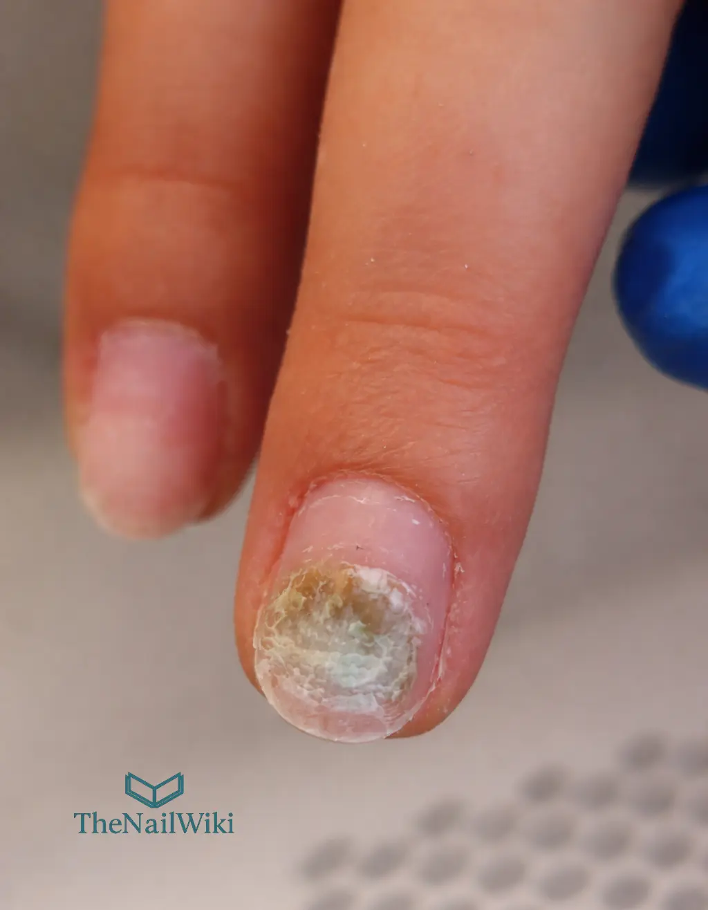 Green nail syndrome visible on the nail plate after acrylic removal — bacterial staining caused by lifting left untreated for approximately five weeks