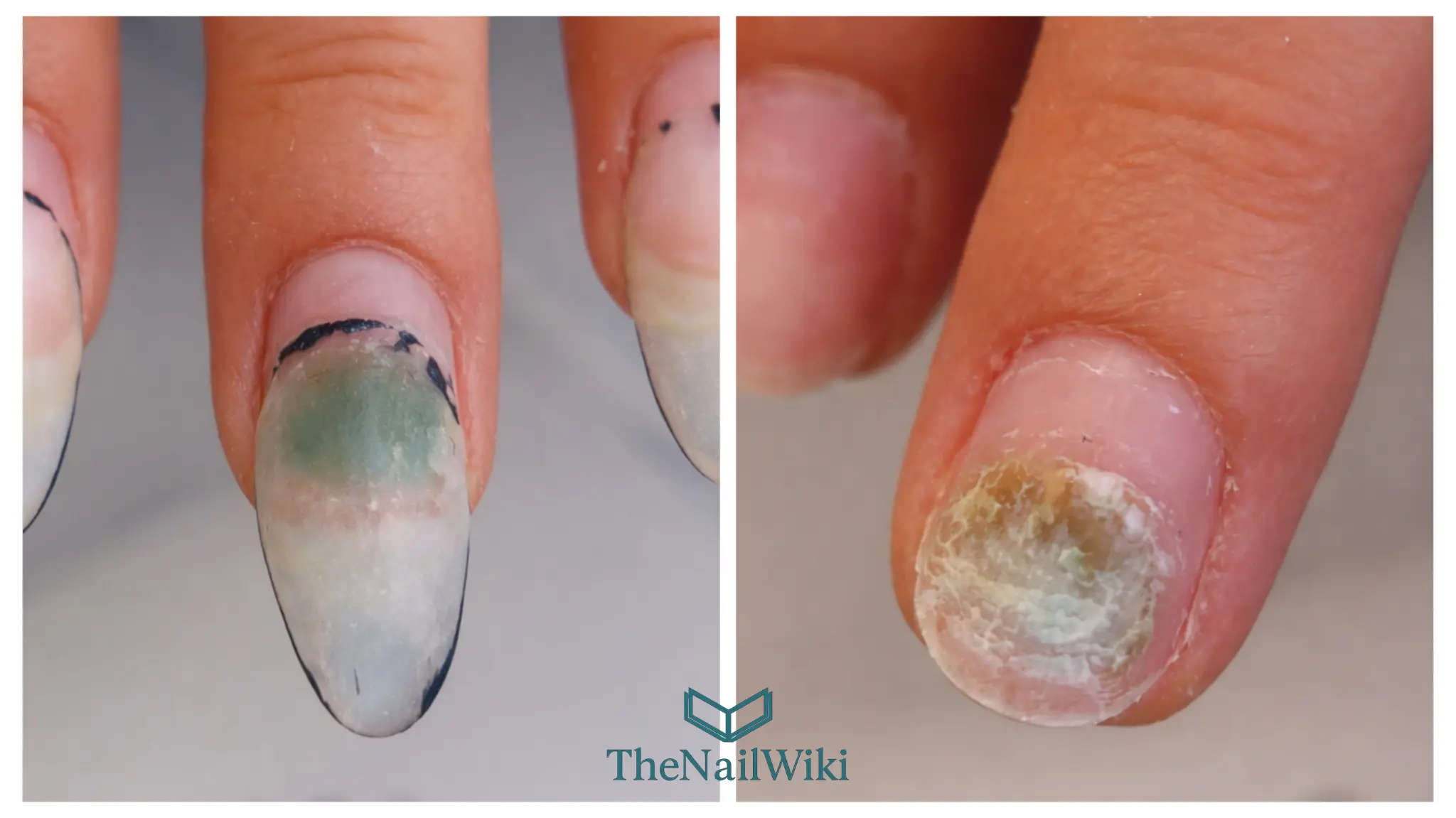 Side-by-side collage showing green nail syndrome visible through lifted acrylic on the left and the affected nail plate after removal on the right