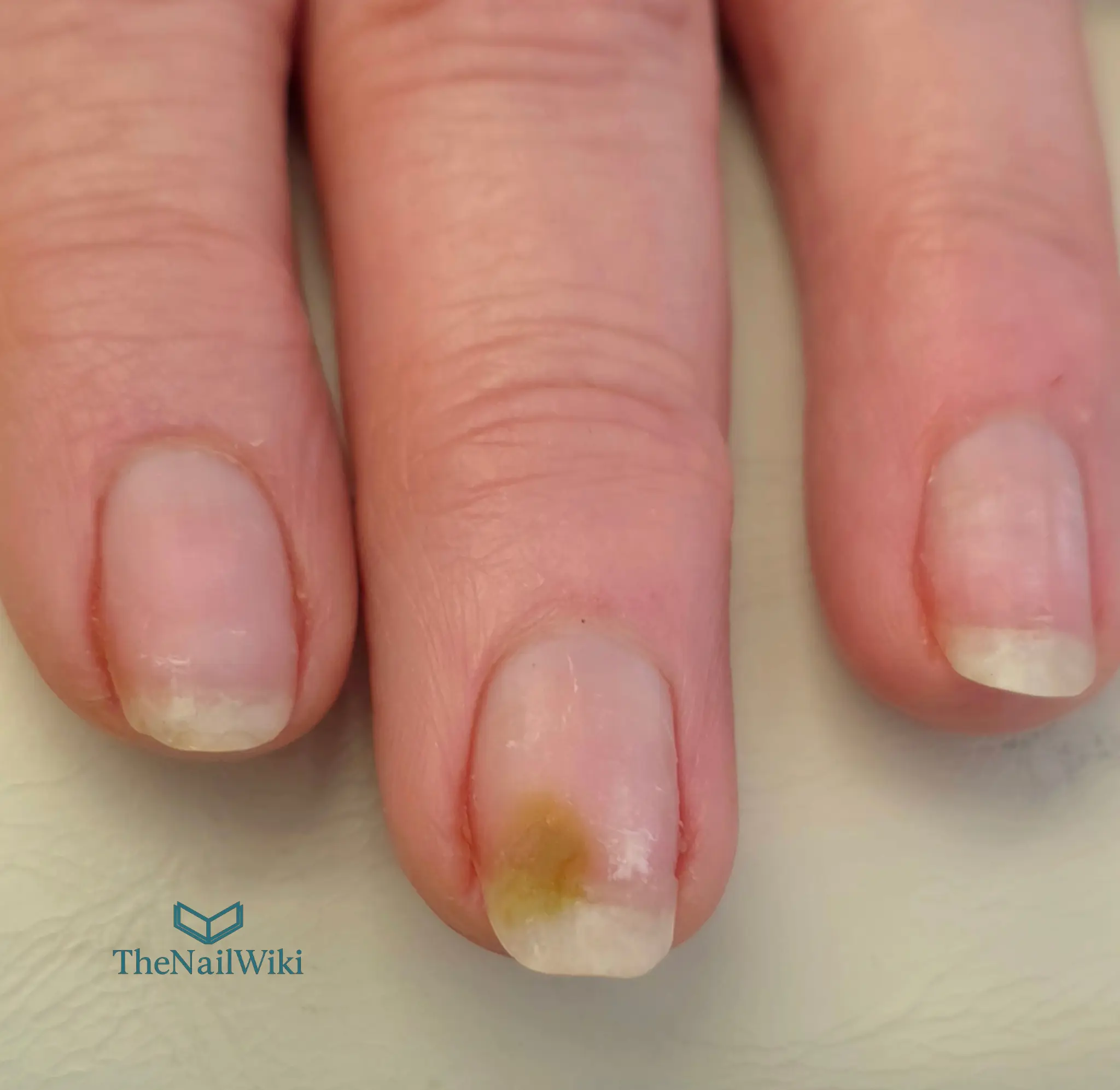 Green nail syndrome on a natural nail caused by product lifting — yellow-green bacterial staining visible at the distal nail bed with surrounding onycholysis