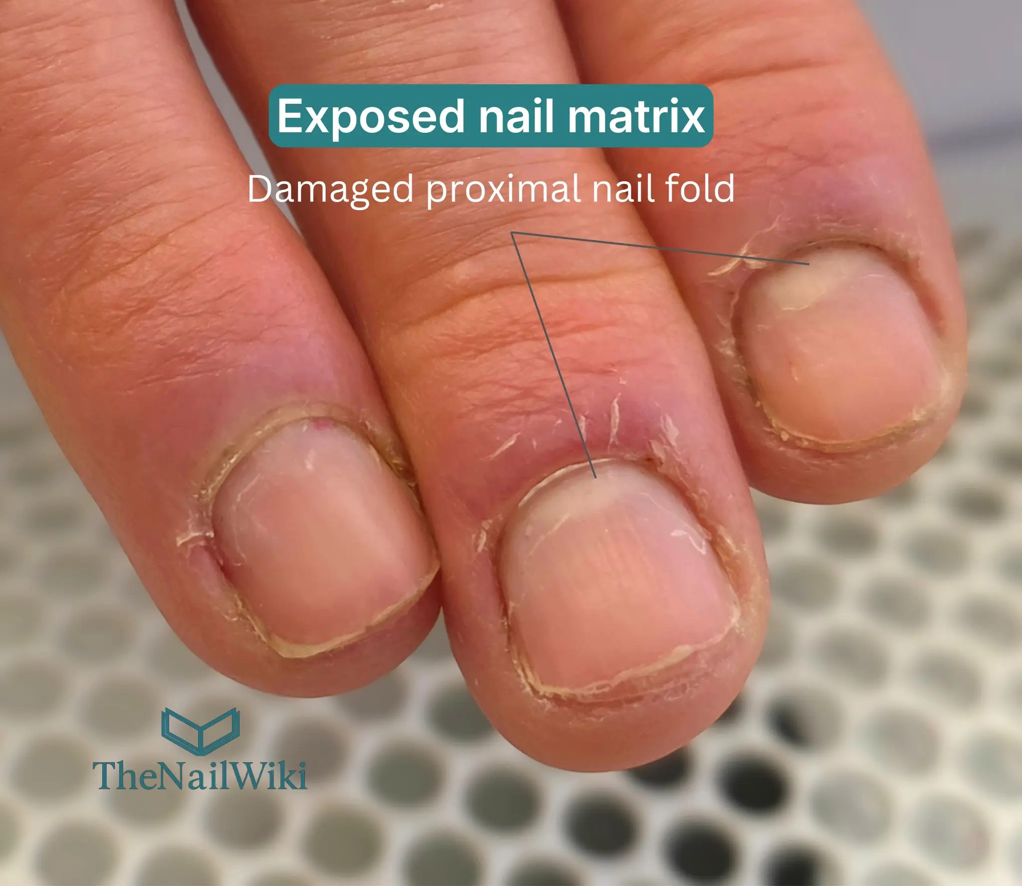 Close-up photograph of severely bitten and picked fingernails showing damaged proximal nail fold, exposed nail matrix, torn lateral nail folds, and irregular nail plate edges resulting from habitual nail biting and picking