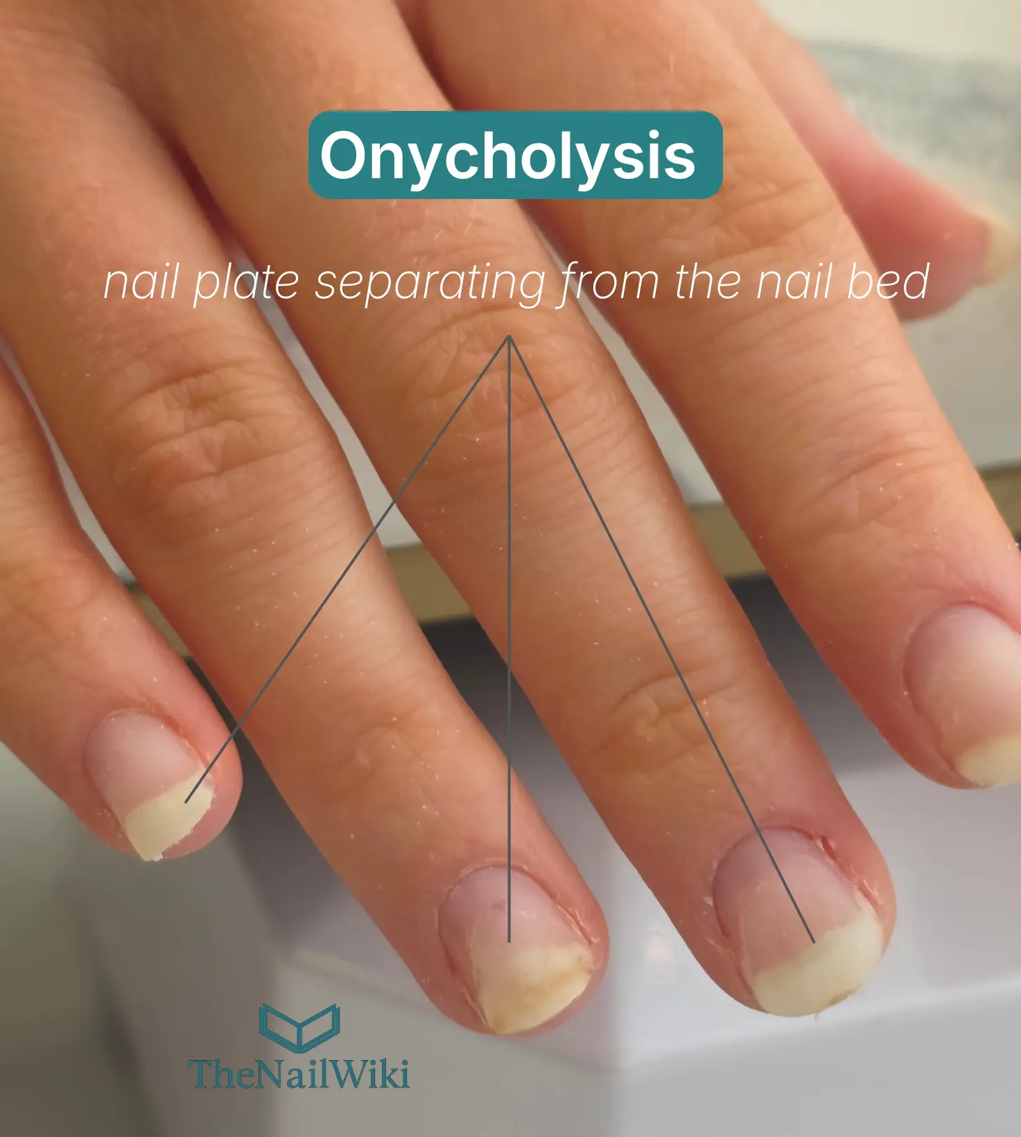 Close-up photograph of three fingernails showing onycholysis — white and yellow discolouration at the free edge caused by the nail plate separating from the nail bed beneath, with arrows indicating the affected areas on multiple digits