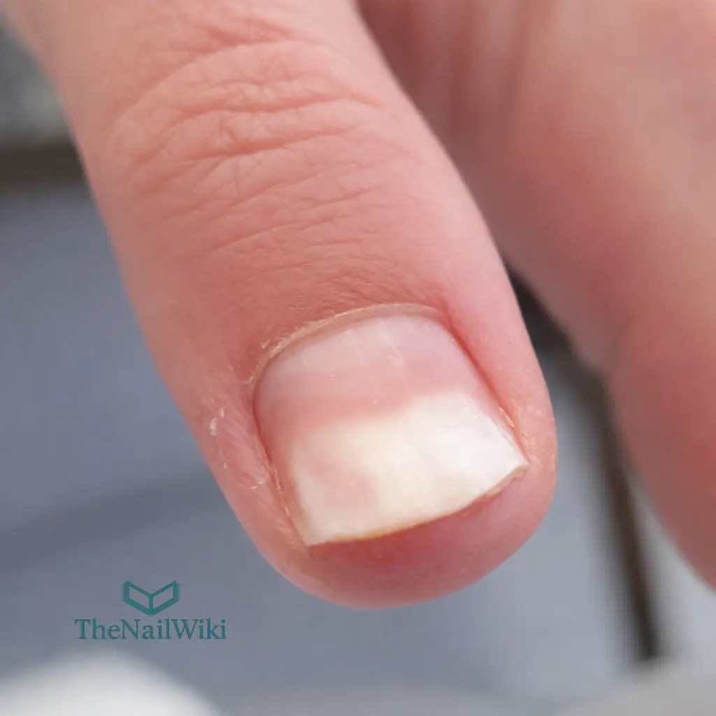 Severe onycholysis affecting nearly half the nail plate caused by overfiling at a salon not operating to professional standards — the client required almost one year of recovery and had not fully healed at the time of writing