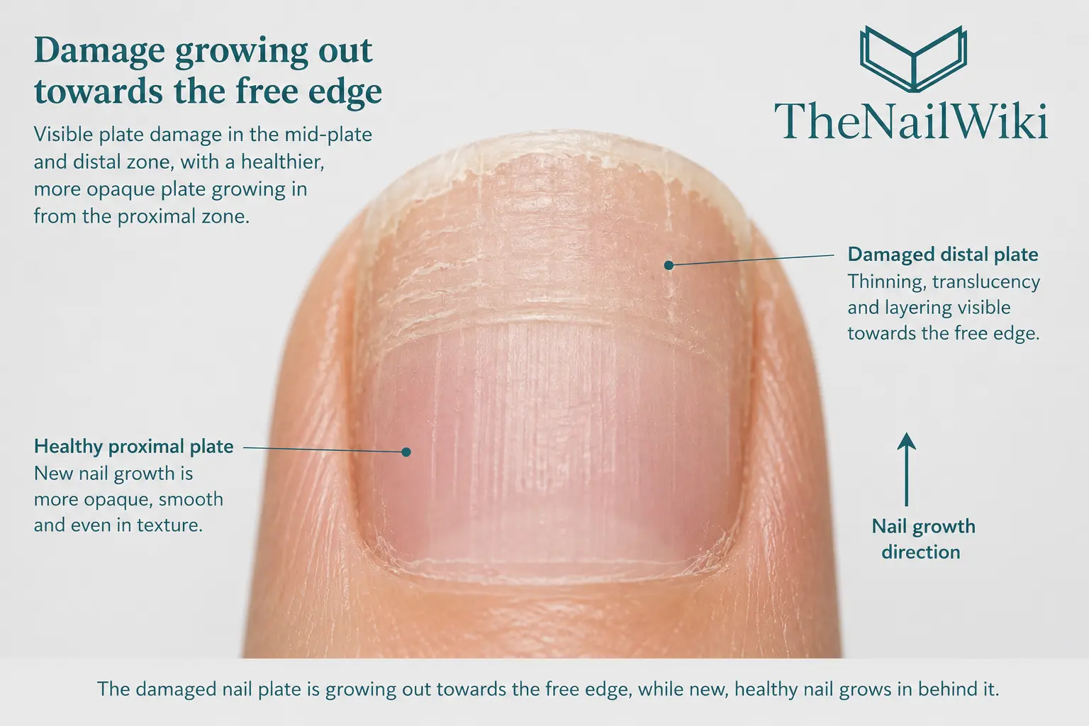 Close-up of nail plate damage growing out towards the free edge — thinning and translucency visible at the distal plate with healthier plate growing in at the proximal zone